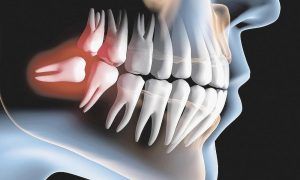 Extração do Dente do Siso, problemas que podem ocasionar o dente do Siso.